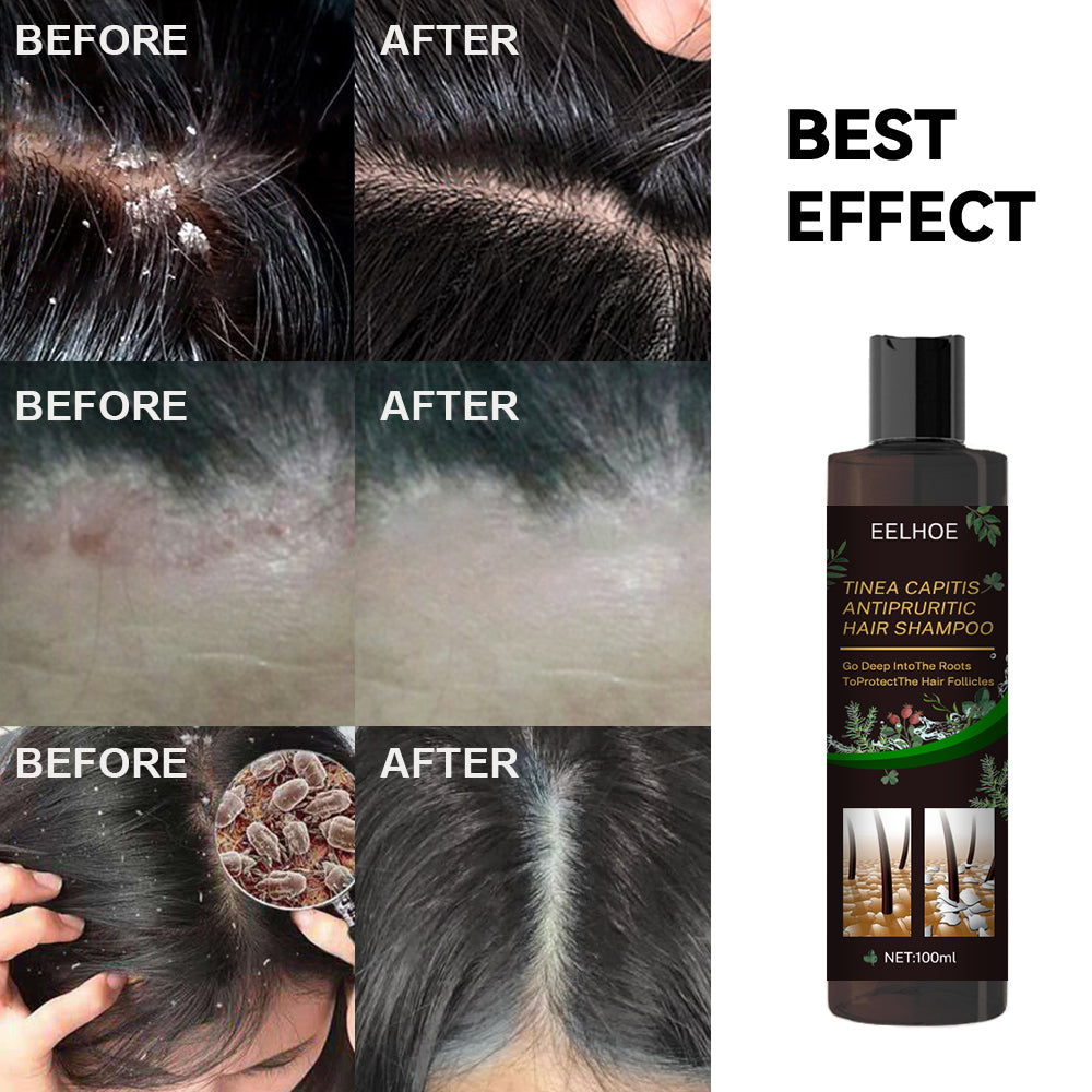 EELHOE Anti-itching Shampoo Anti-refreshing Oil Control Hair Care Anti-dandruff Anti-itching Shampoo